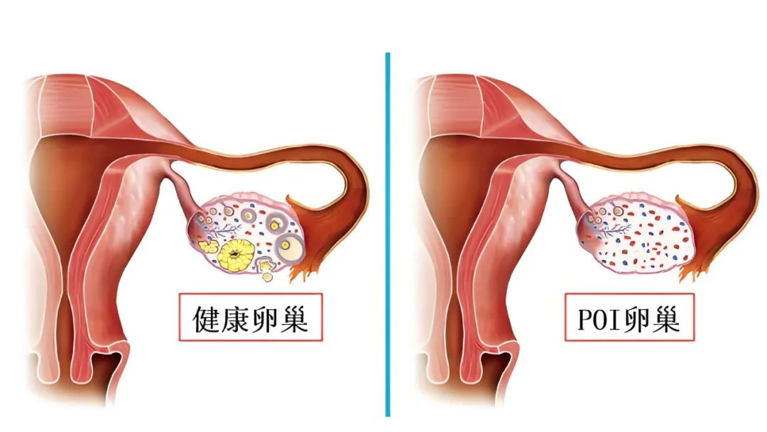 有些卵巢早衰，从出生那一刻就决定了.....
