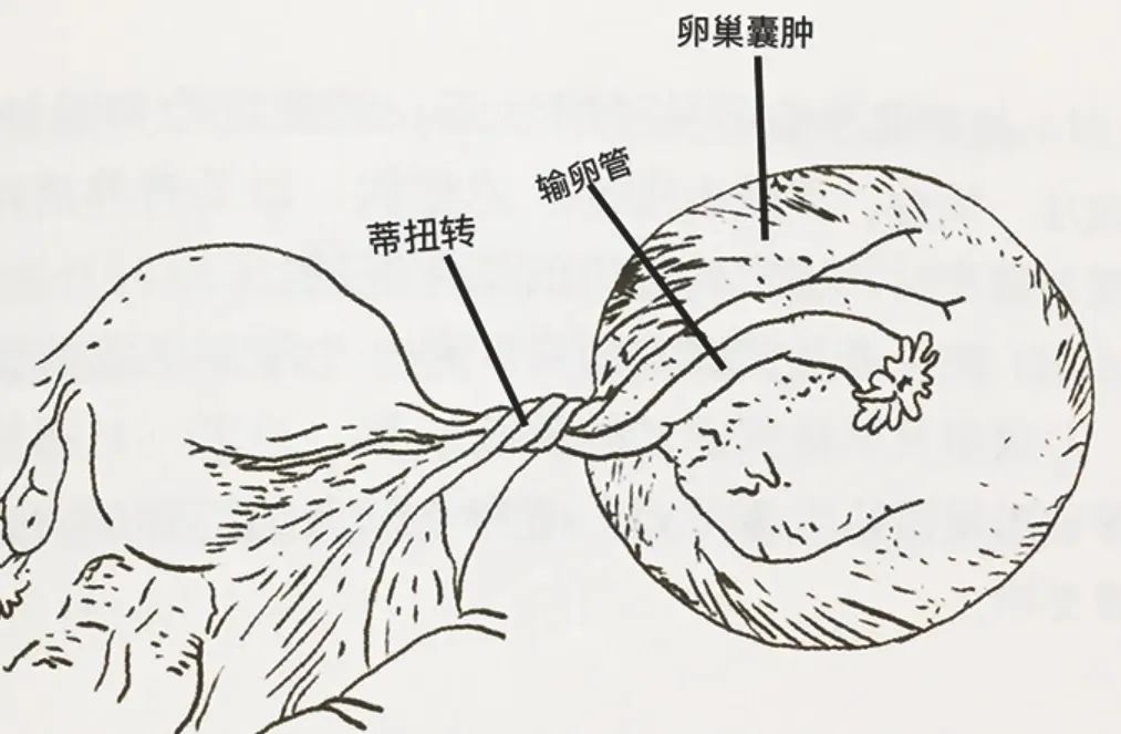 卵巢囊肿这个“沉默杀手”，居然成了致命病因！