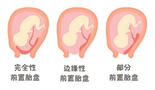 胎儿发出的6个“求救”信号，孕妈妈要知道！