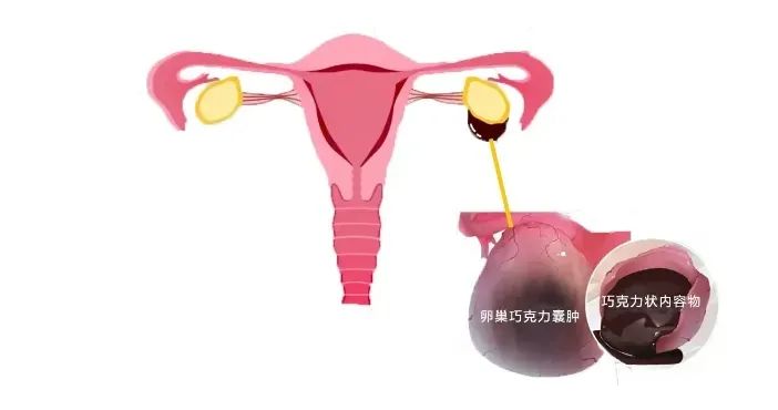 卵巢囊肿这个“沉默杀手”，居然成了致命病因！