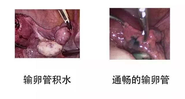 想怀孕，为什么医生却建议我切除输卵管？