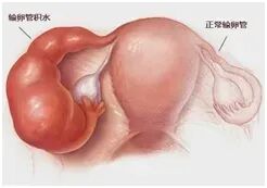想怀孕，为什么医生却建议我切除输卵管？