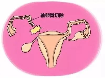 想怀孕，为什么医生却建议我切除输卵管？