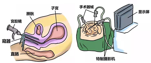 这4种情况需要做宫腔镜，千万别耽误治疗！