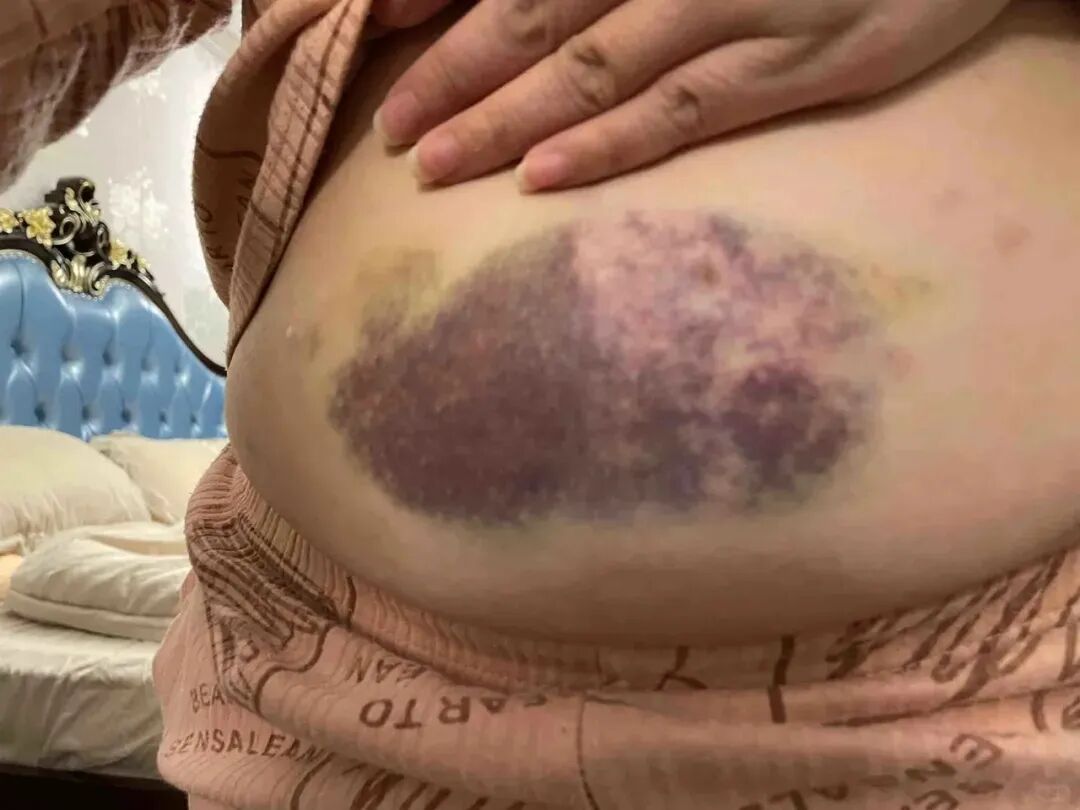 保胎“神药”低分子肝素，用不对效果减半！