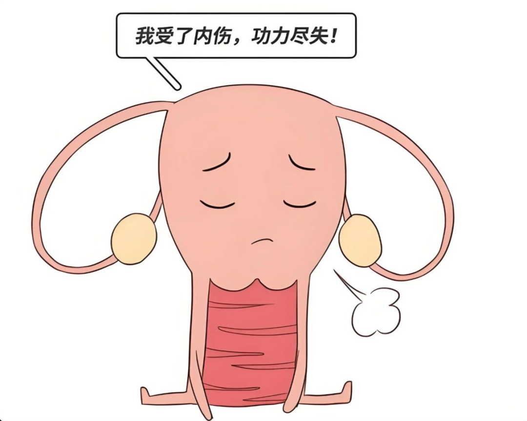 宫腔粘连：一个悄悄带走月经的“小偷”！