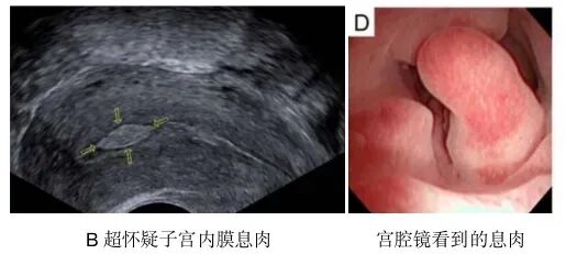 这4种情况需要做宫腔镜，千万别耽误治疗！