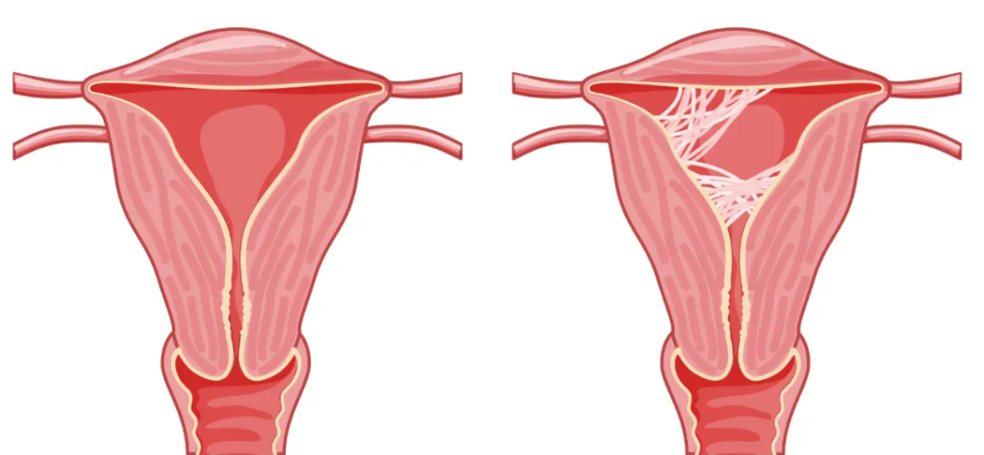 宫腔粘连：一个悄悄带走月经的“小偷”！