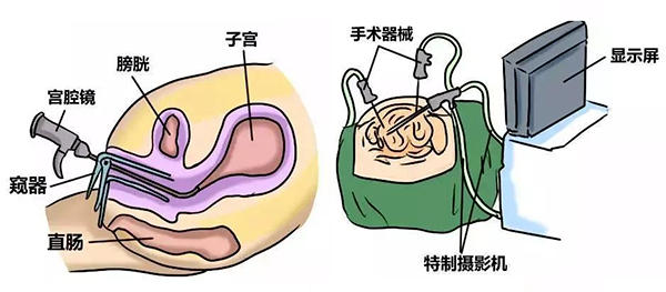 宫腔粘连：一个悄悄带走月经的“小偷”！