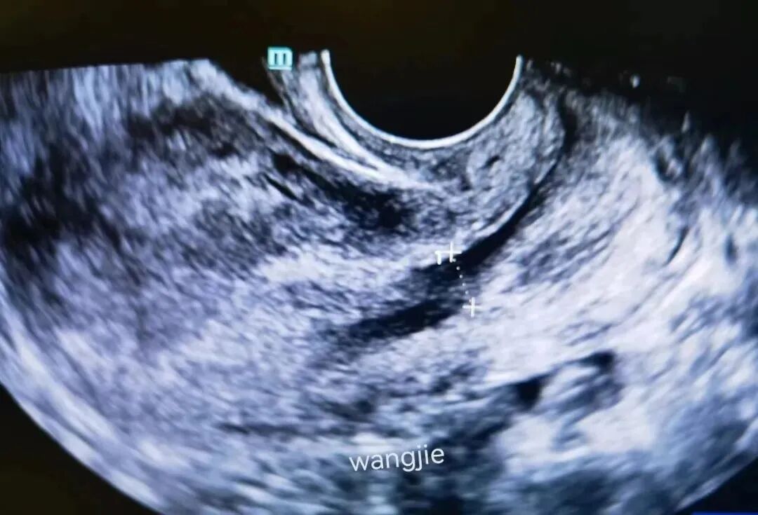 孕期的“小插曲”——妊娠期蜕膜息肉！