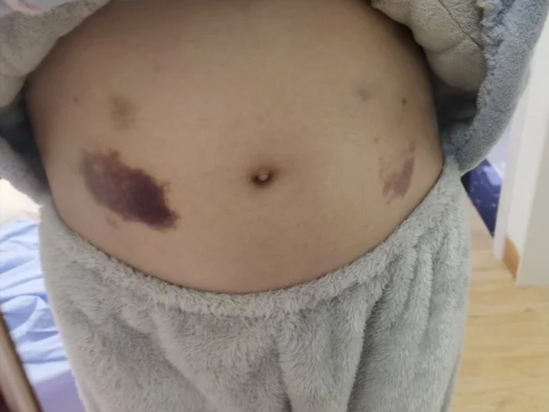 保胎“神药”低分子肝素，用不对效果减半！