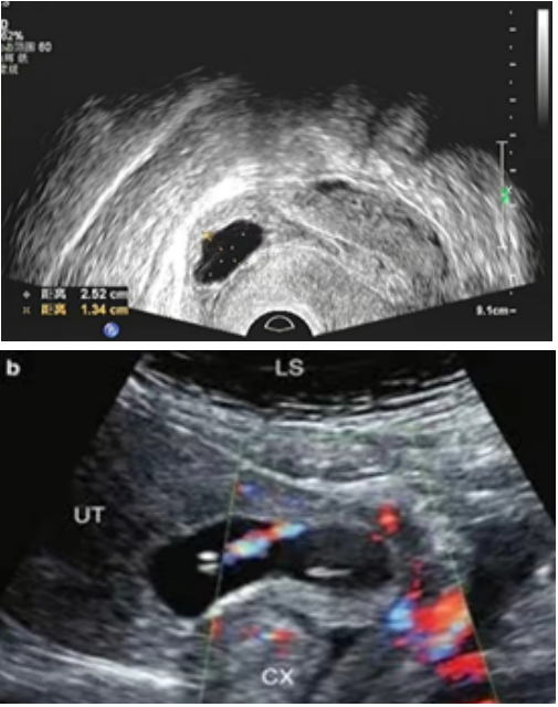 剖宫产后再次怀孕，这个“拦路虎”要小心！