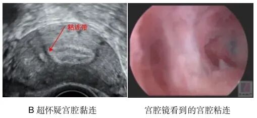 这4种情况需要做宫腔镜，千万别耽误治疗！