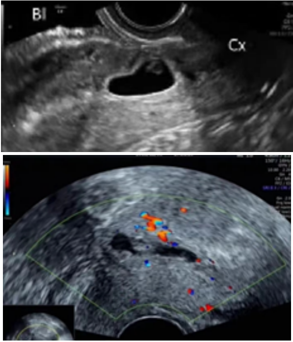 剖宫产后再次怀孕，这个“拦路虎”要小心！