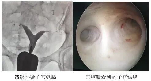 这4种情况需要做宫腔镜，千万别耽误治疗！