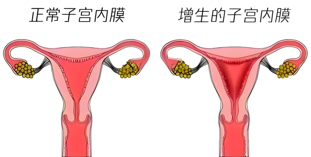 为什么说子宫衰老也是生育的“隐藏杀手”？
