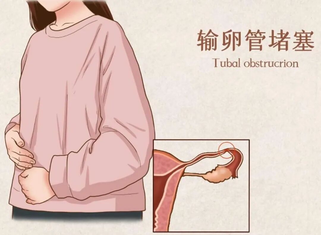 久备不孕？也许是输卵管在“悄悄”堵塞