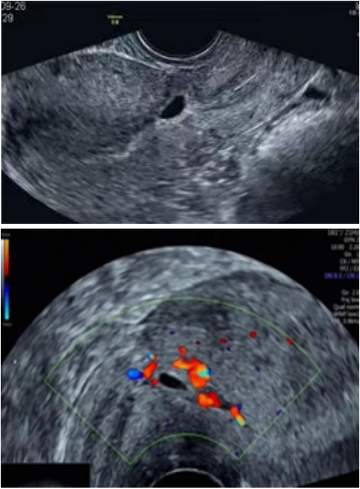 剖宫产后再次怀孕，这个“拦路虎”要小心！