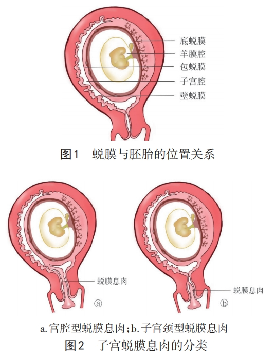 孕期的“小插曲”——妊娠期蜕膜息肉！
