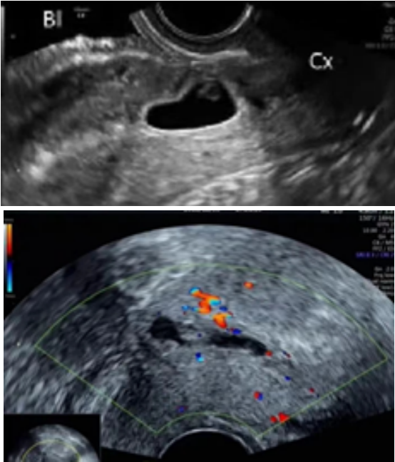剖宫产后再次怀孕，这个“拦路虎”要小心！