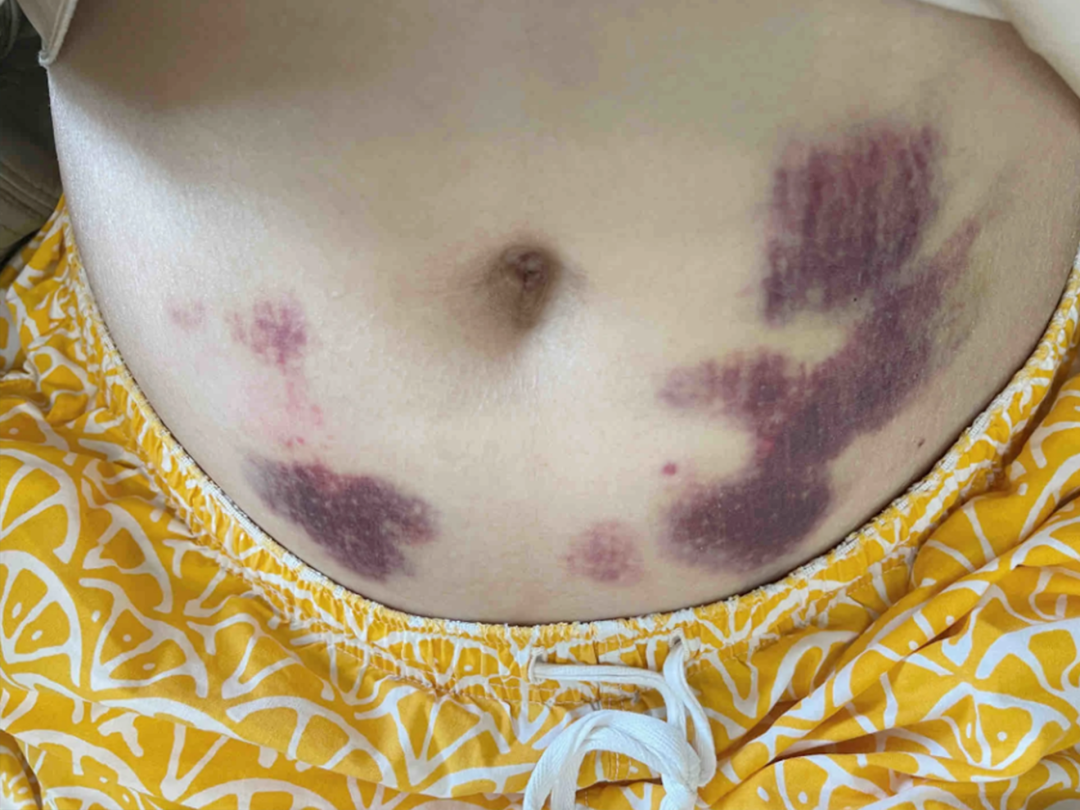 保胎“神药”低分子肝素，用不对效果减半！