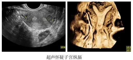 这4种情况需要做宫腔镜，千万别耽误治疗！