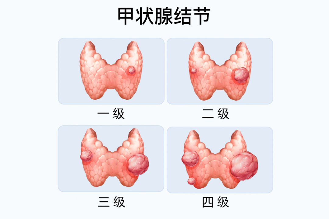 同型半胱氨酸,藏着甲状腺健康信号!